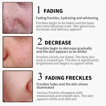 LAIKOU Ren Kridtning Fregne Facial Cream Reparation Fjerne Melasma Acne, Pletter, Pigment Melanin Mørke Pletter i Huden Lysere Creme